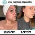 Acne Pads & Cleanser Combo