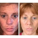 Dark Spot Corrector Remover Face Melasma Treatment Fade Cream 2% Hydroquinone