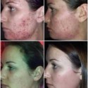 LUMINESCE™ Cleanser & Serum for Blemishes-Pimples-Acne-Potholes-Scars